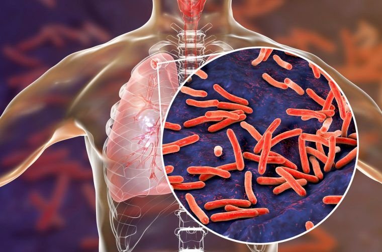 Lee más sobre el artículo Tuberculosis en aumento en Santander: 1.031 casos y 49 muertes en lo corrido de 2025